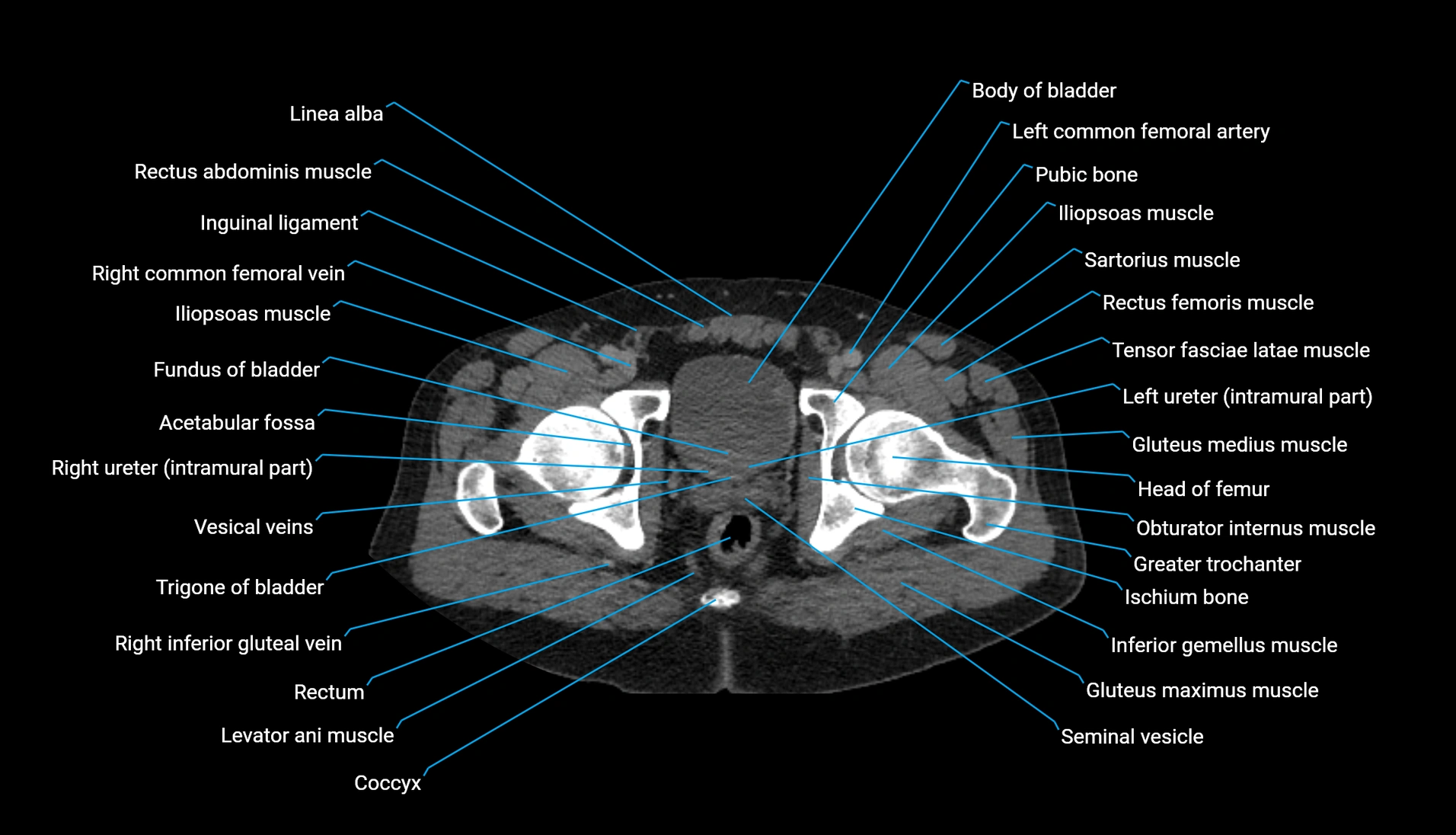 CT urogram axial cross sectional anatomy  labelled radiology image-00238.webp
